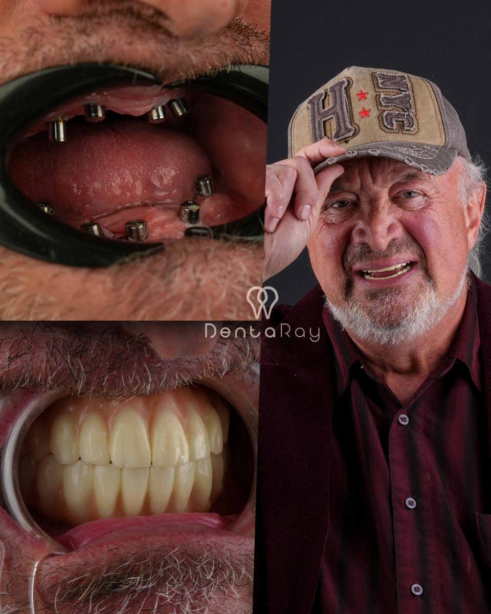 نتائج زراعة الأسنان All-on-6 قبل وبعد في عيادة DentaRay، استعادة الابتسامة الكاملة