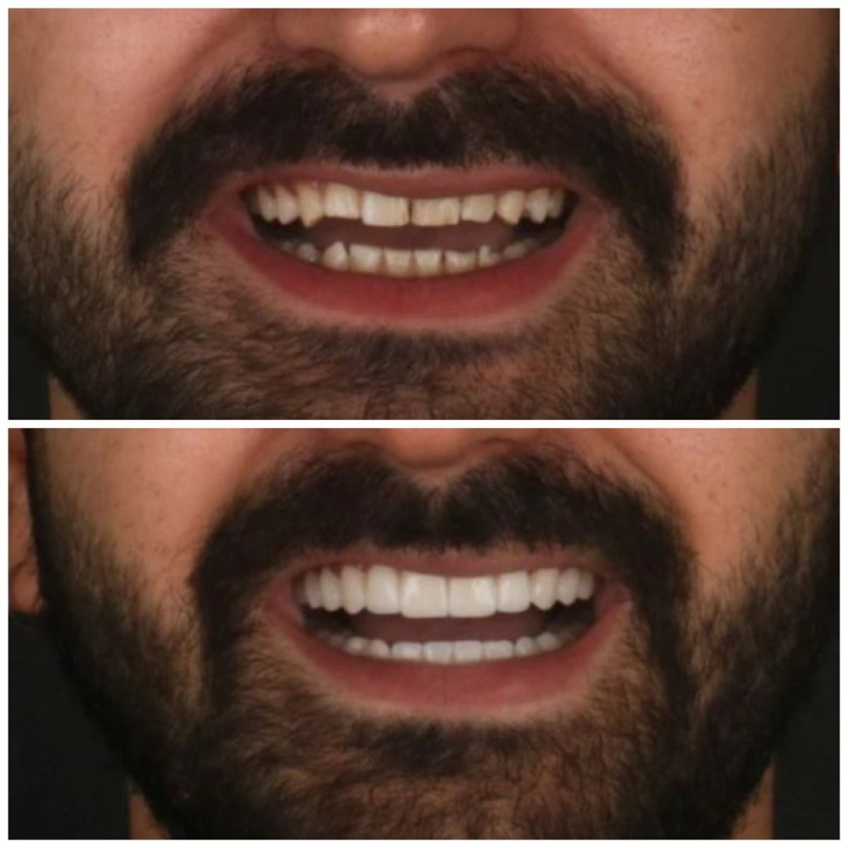 نتائج تبييض الأسنان قبل وبعد في Idea Dental Clinic، ابتسامة أكثر إشراقًا بشكل ملحوظ