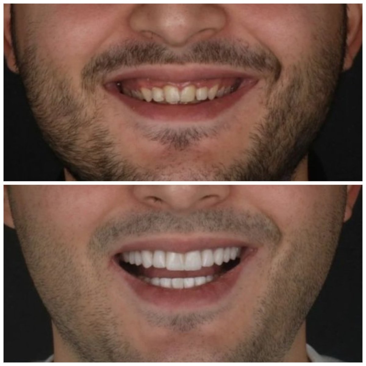 Avant et après facettes dentaires à Idea Dental Clinic, transformation naturelle du sourire