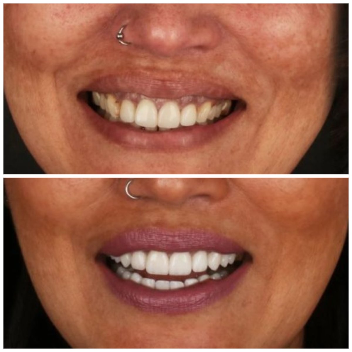 Before and after veneers at Idea Dental Clinic – smile makeover with natural-looking results
