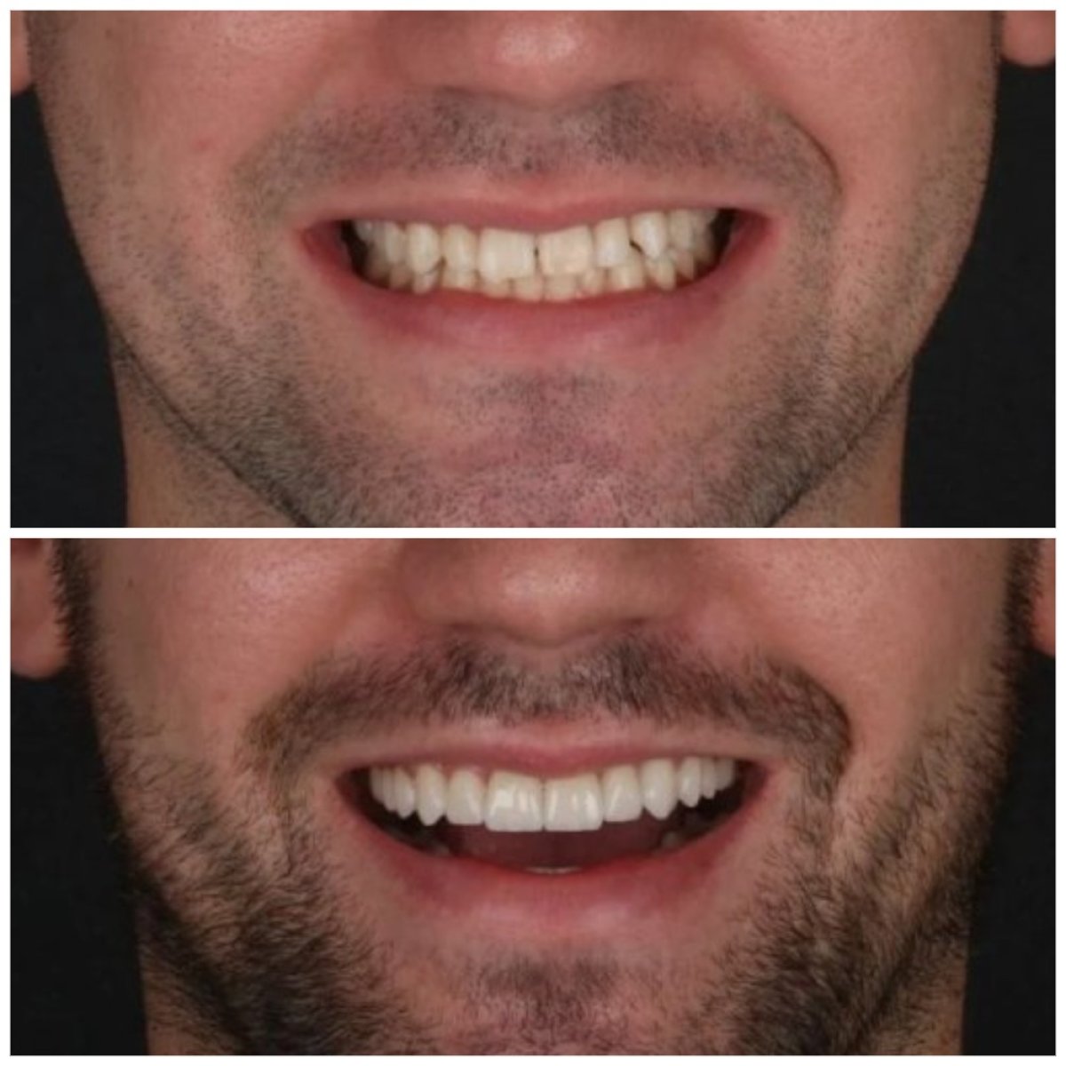 Before and after veneers result at Idea Dental Clinic – improved smile and whiter teeth
