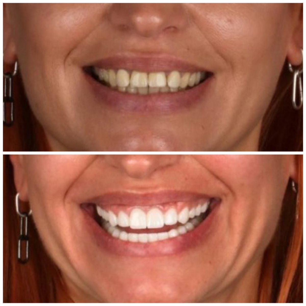 Before and after Hollywood Smile results at Idea Dental Clinic – brighter, even teeth transformation
