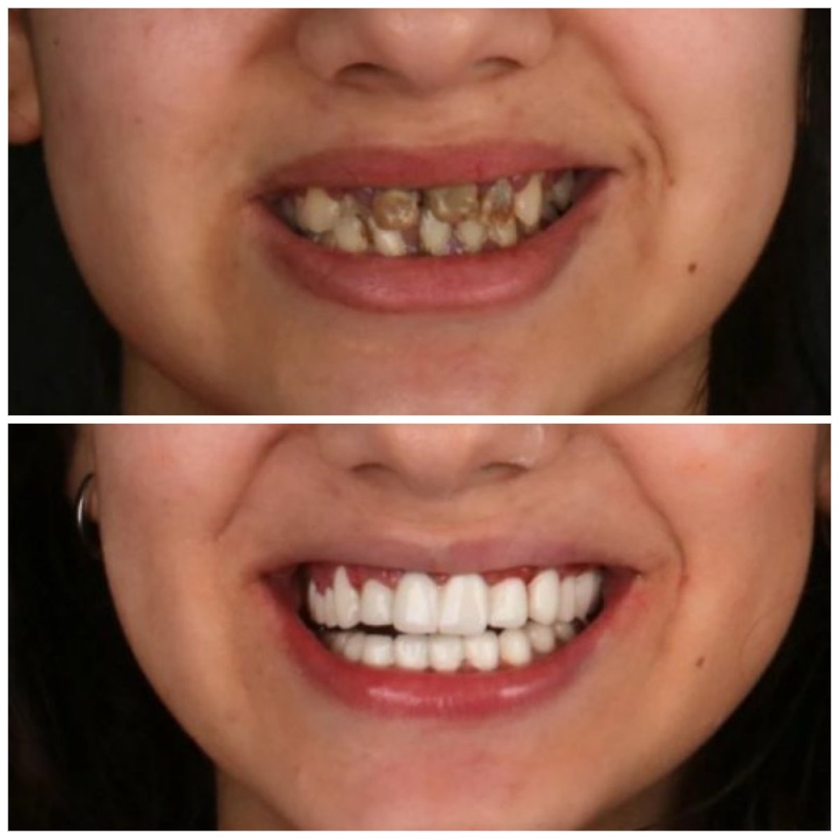 Before and after veneers at Idea Dental Clinic, smile transformation with natural-looking results
