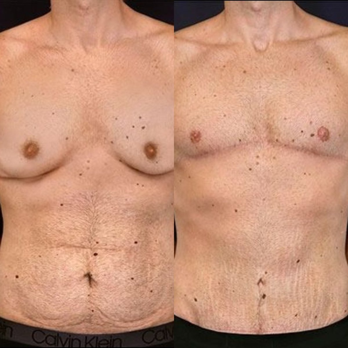 Before and after gynecomastia surgery results at Dr. Alexandro Aguilera - Plastic Surgery clinic