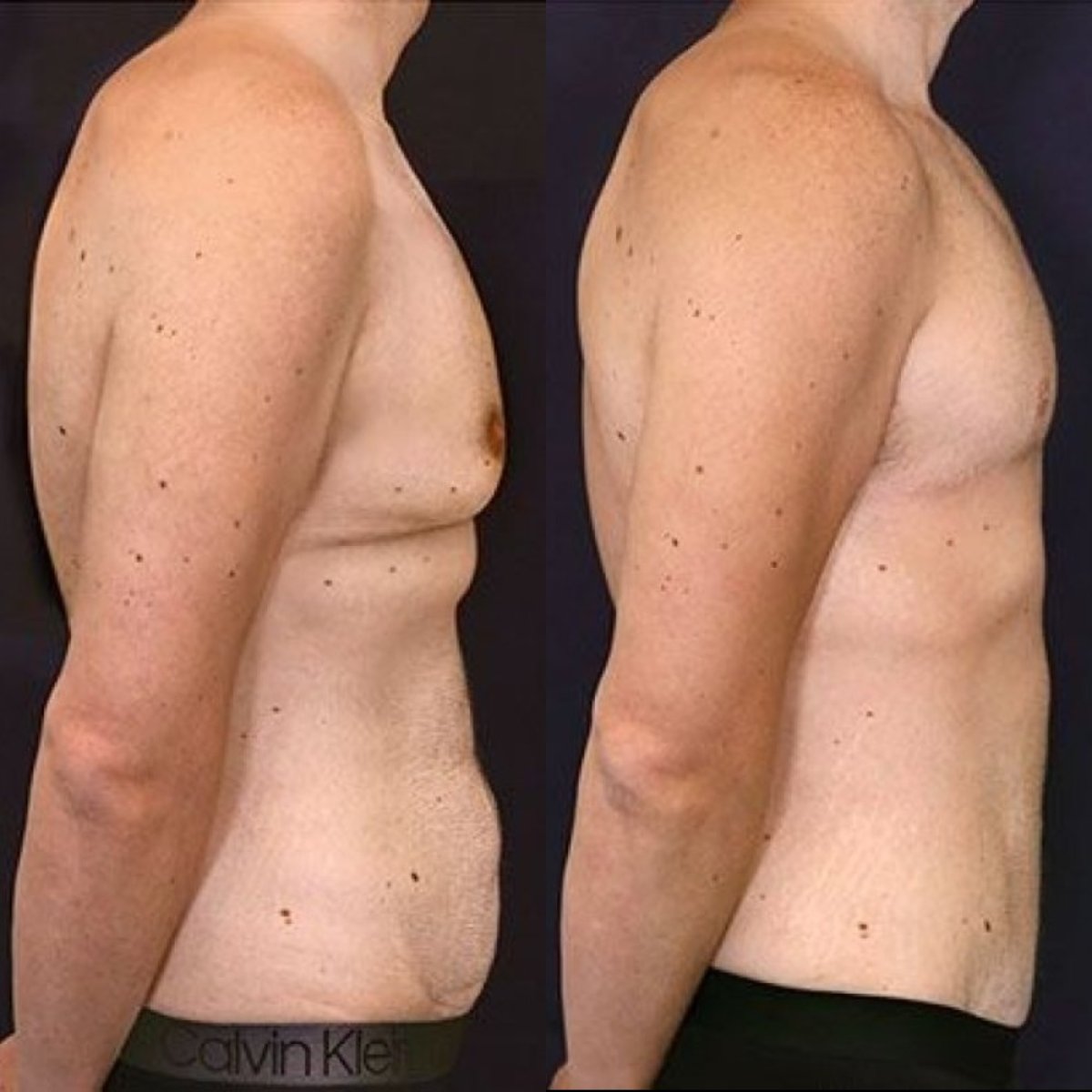 Before and after gynecomastia surgery results at Dr. Alexandro Aguilera - Plastic Surgery clinic