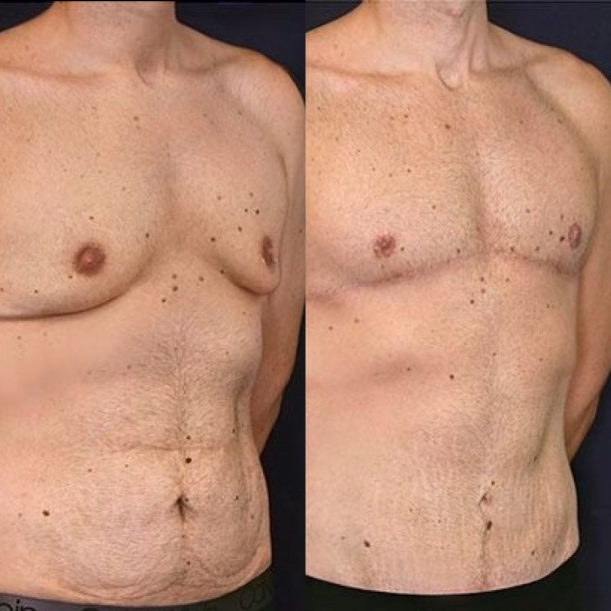 Результати до і після операції гінекомастії в клініці Dr. Alexandro Aguilera - Plastic Surgery