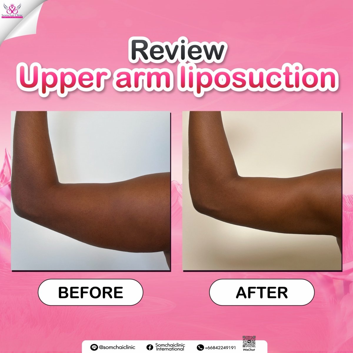 Upper arm liposuction before and after results at Somchai Clinic, visible arm contouring