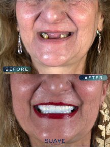Single Implant with 4* Hotel stay and VIP Transfer - photo 5