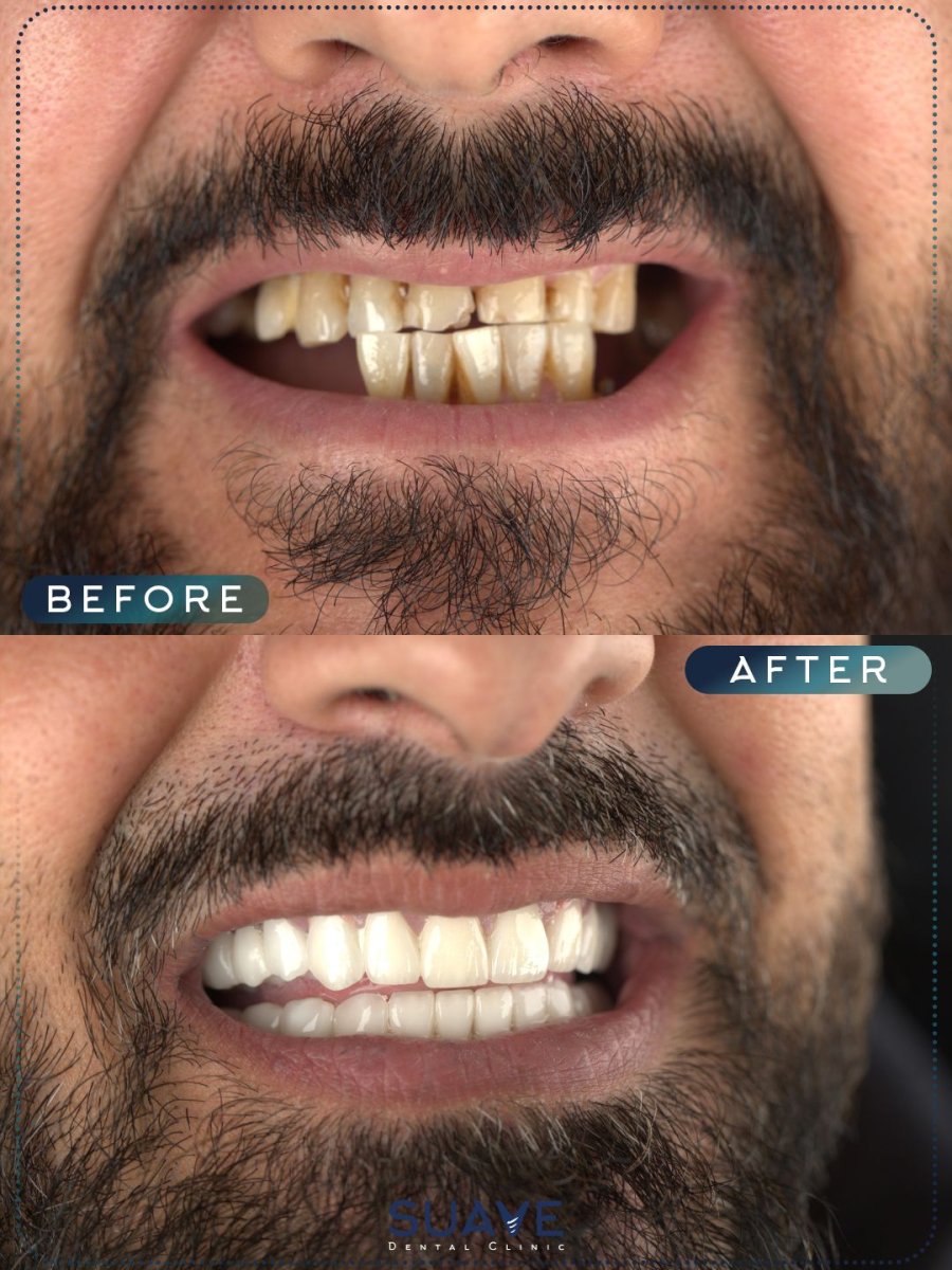 Before and after All-on-4 dental implants result at SUAVE DENTAL CLINIC, smile restoration