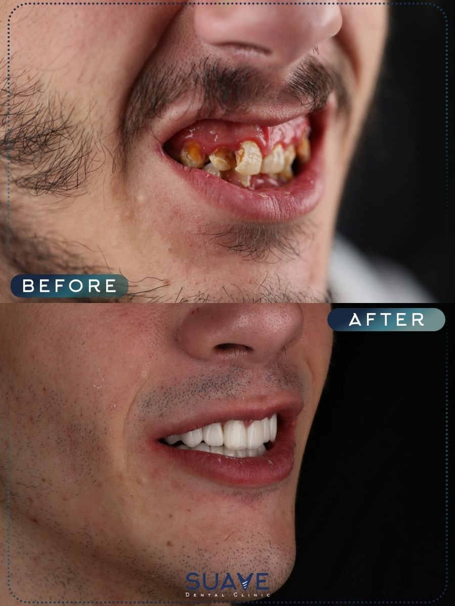 Результаты до и после имплантации зубов в SUAVE DENTAL CLINIC — восстановленная улыбка