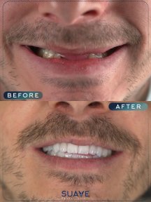 Single Implant with 4* Hotel stay and VIP Transfer - photo 4