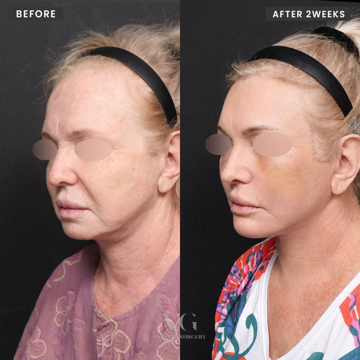 نتائج شد الوجه قبل وبعد في VG Plastic Surgery – تجديد واضح للوجه بعد أسبوعين