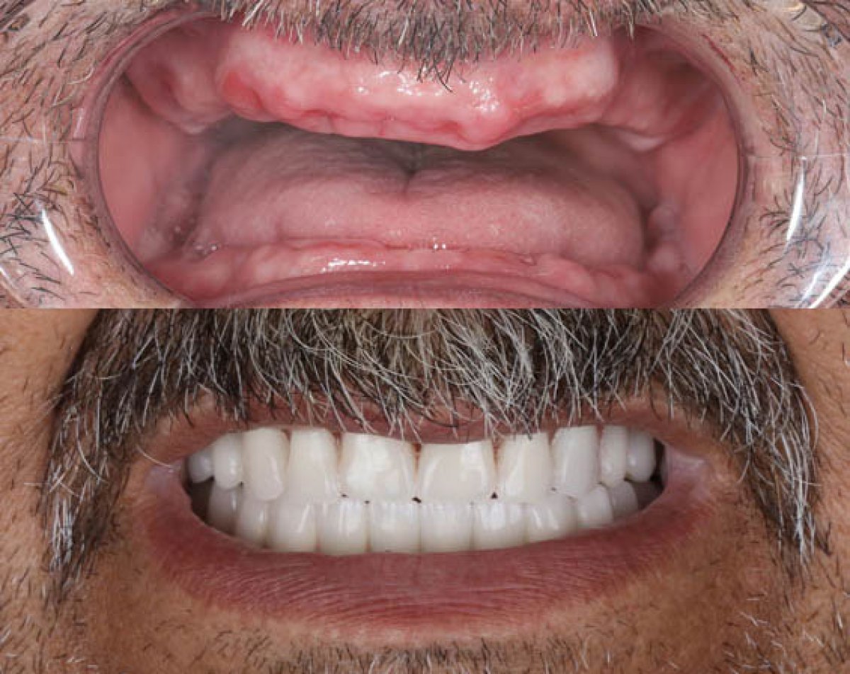 Before and after All-on-4 dental implants result – full smile restoration for missing teeth