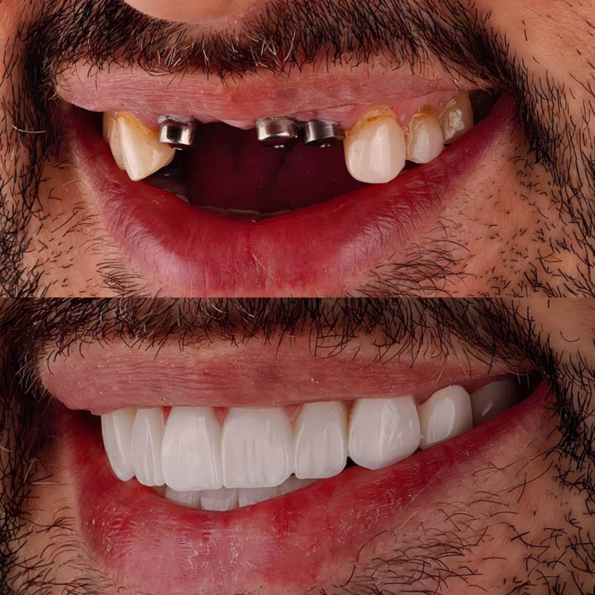 Resultados antes y después de implantes dentales All-on-4: restauración completa de la sonrisa