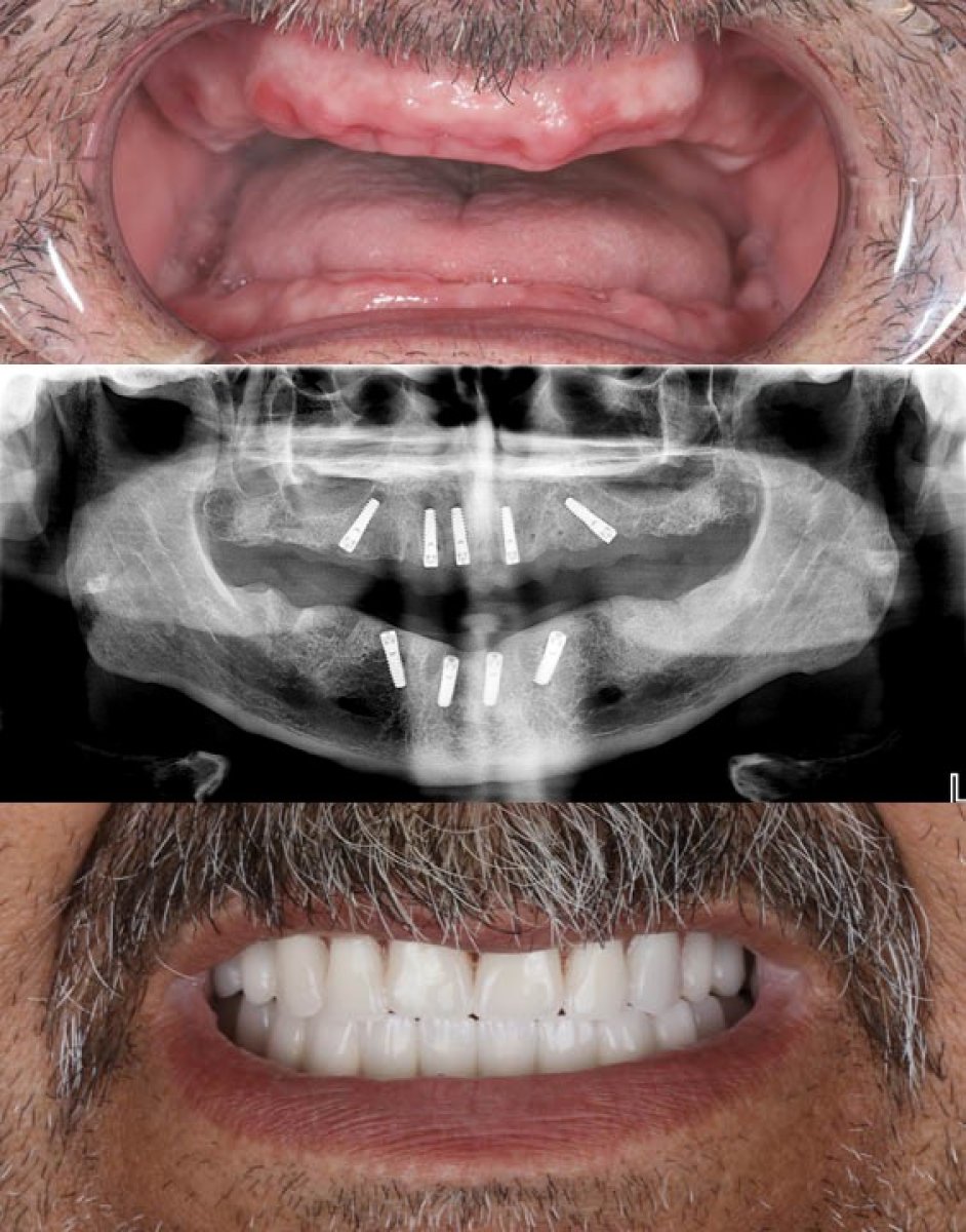 All-on-4 dental implants before and after results – full arch restoration and improved smile