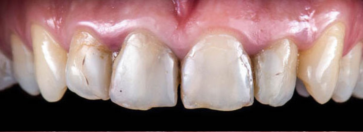 Before laser teeth whitening at clinic – visible tooth discoloration and staining result
