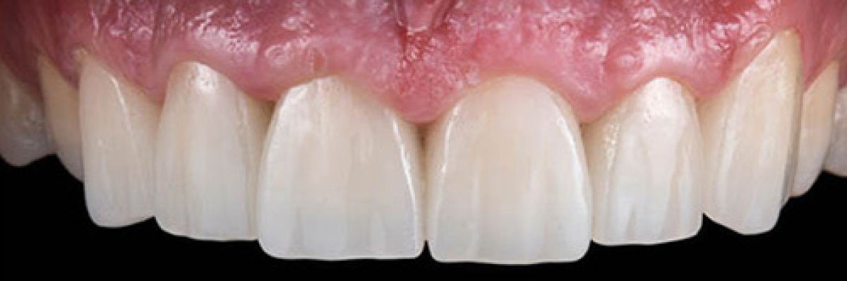 Laser teeth whitening result – visibly brighter smile after procedure at dental clinic