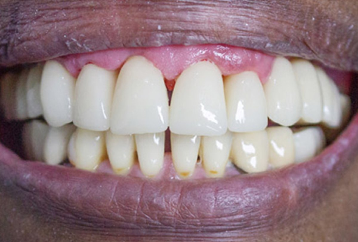 Dental crown installation result – restored teeth alignment and improved smile aesthetics