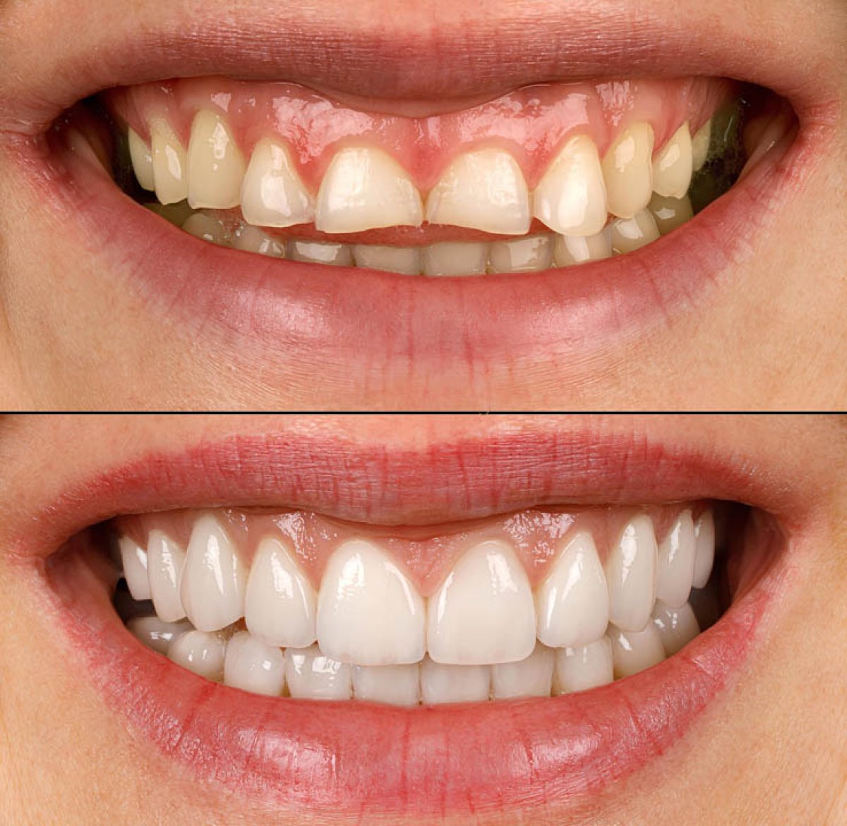 Before and after dental crown installation results – improved smile aesthetics and tooth shape