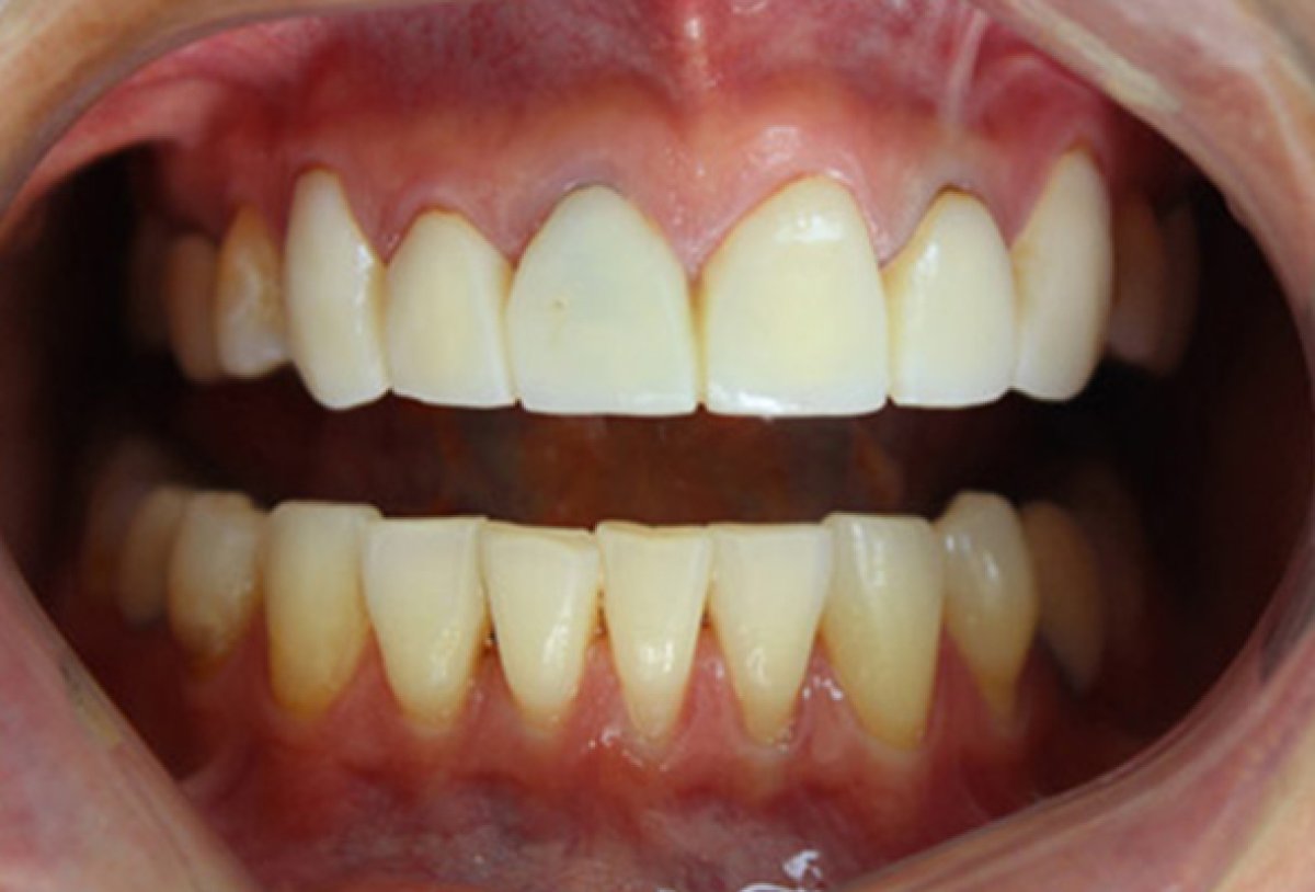 Résultats avant/après détartrage dentaire – élimination de la plaque et dents plus blanches