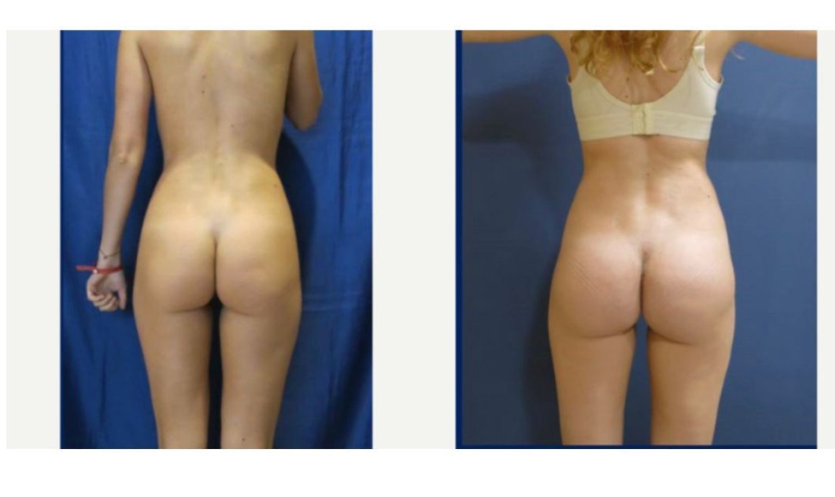 Antes y después de implantes de glúteos en Memorial Şişli Hospital, resultados mejorados