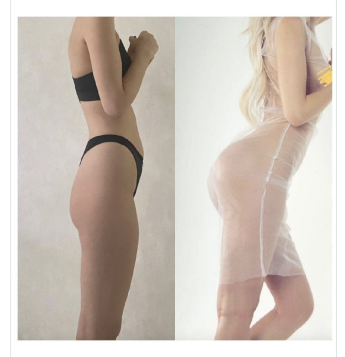 Before and after butt implants at Memorial Şişli Hospital, enhanced curves and volume result