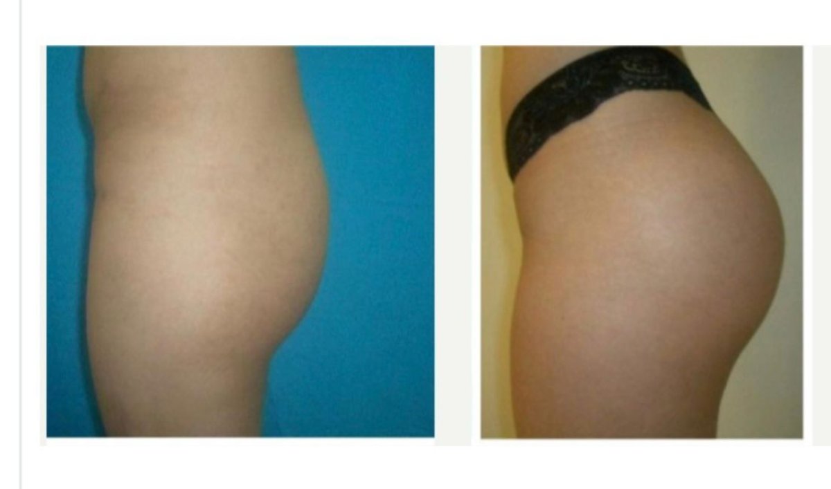 Before and after butt implants at Memorial Şişli Hospital, enhanced gluteal contour result