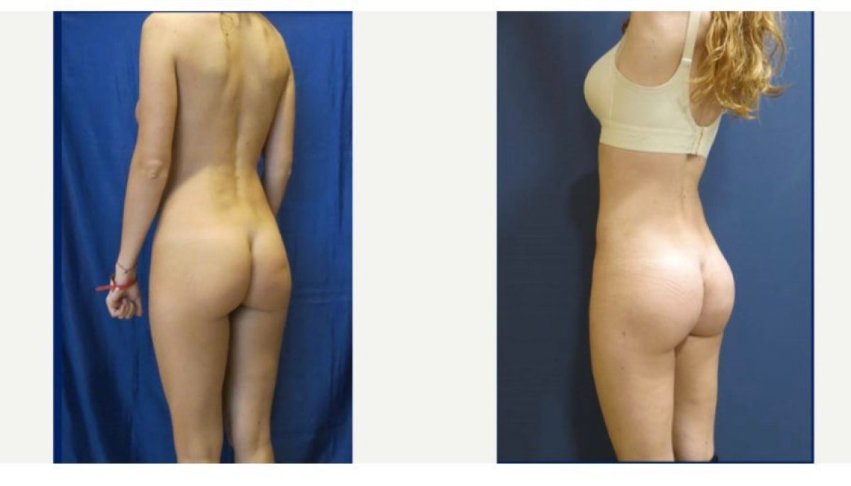 Antes y después de implantes de glúteos en Memorial Şişli Hospital, resultado mejorado
