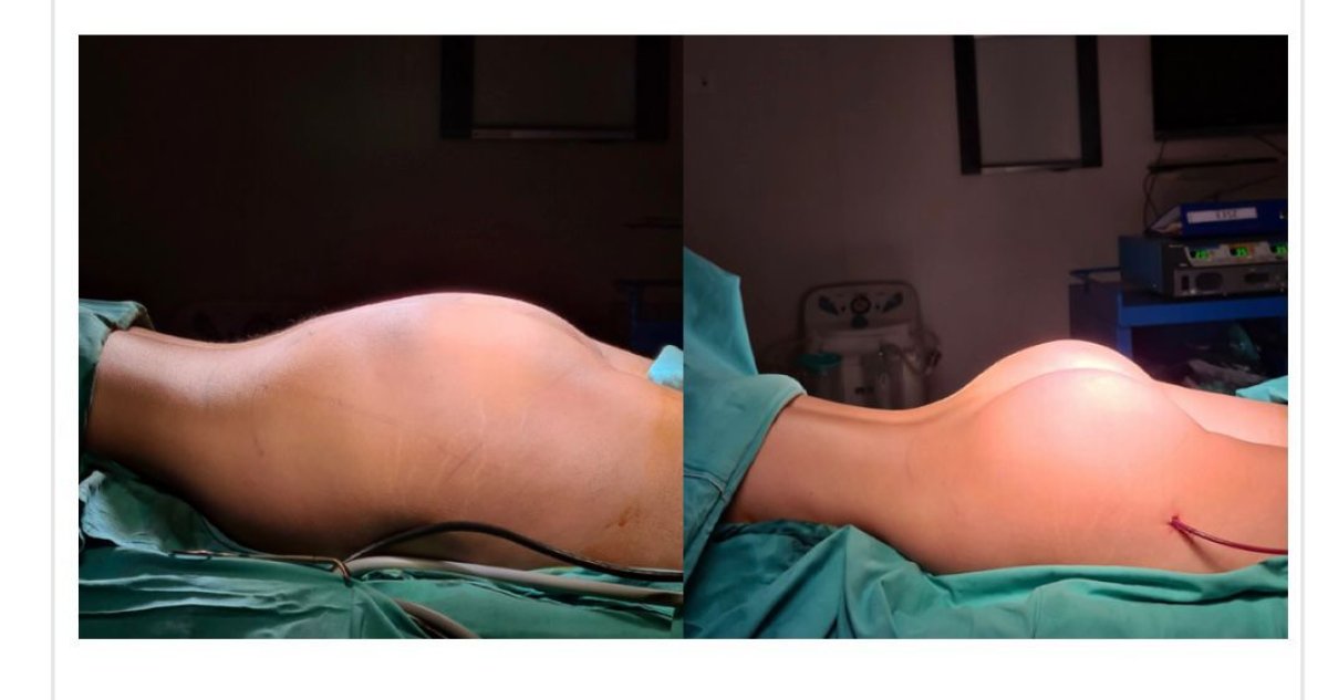 Before and after butt implants at Memorial Şişli Hospital, enhanced gluteal contour result
