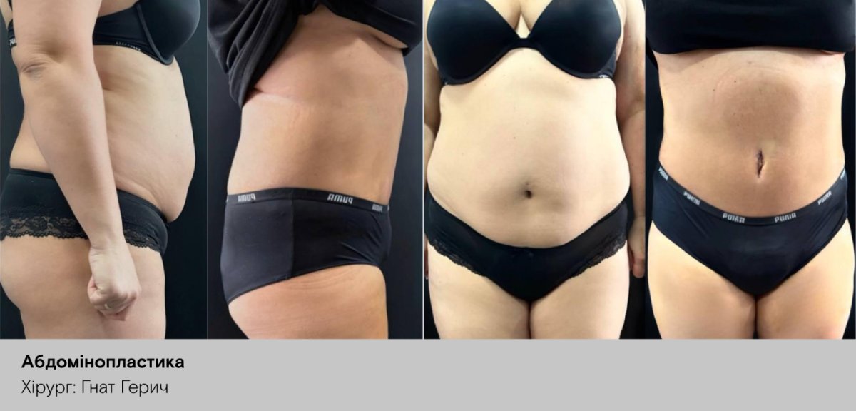 Before and after tummy tuck results, visible abdominal contour improvement after abdominoplasty