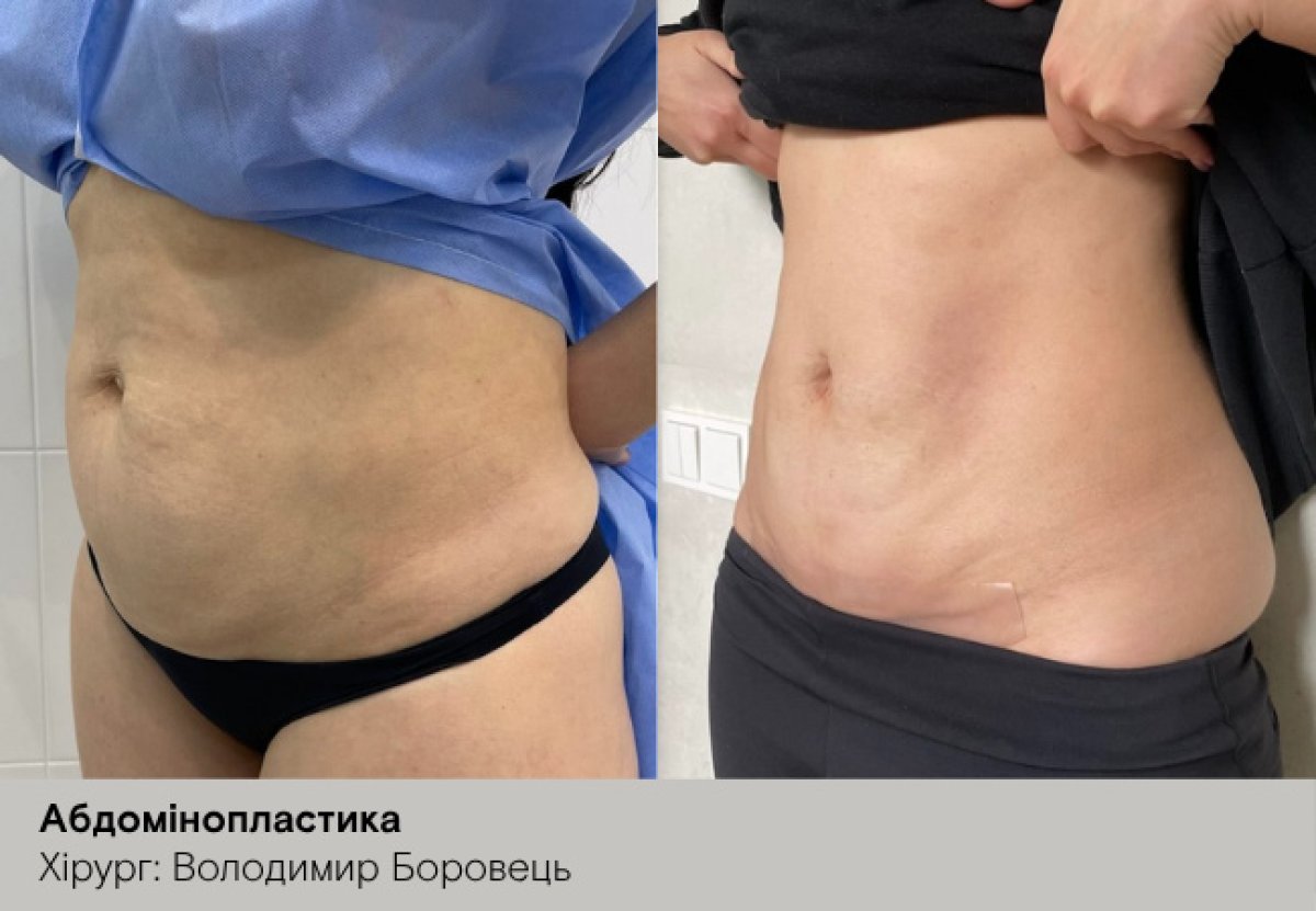 Before and after tummy tuck results, visible abdominal contour improvement after abdominoplasty