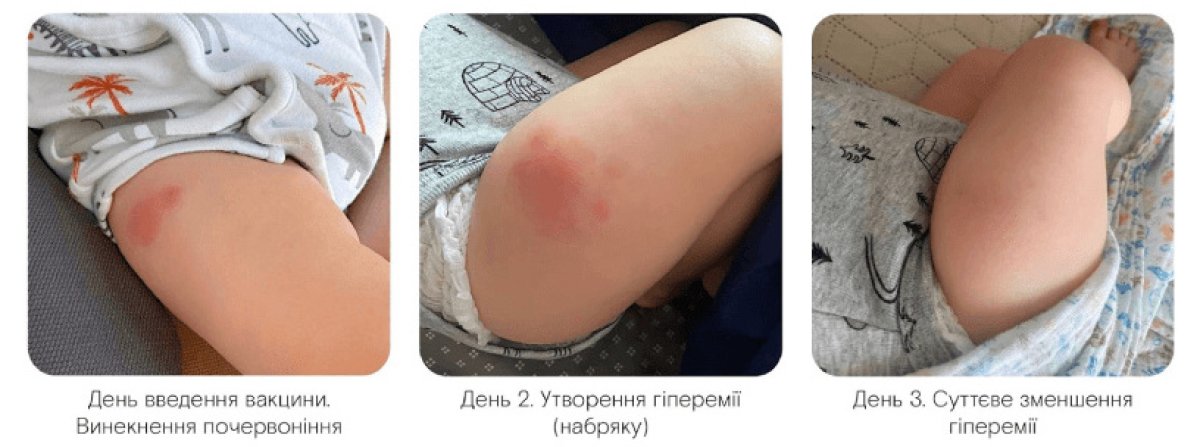 Vaccination aftercare results in child – redness and swelling reduction over three days