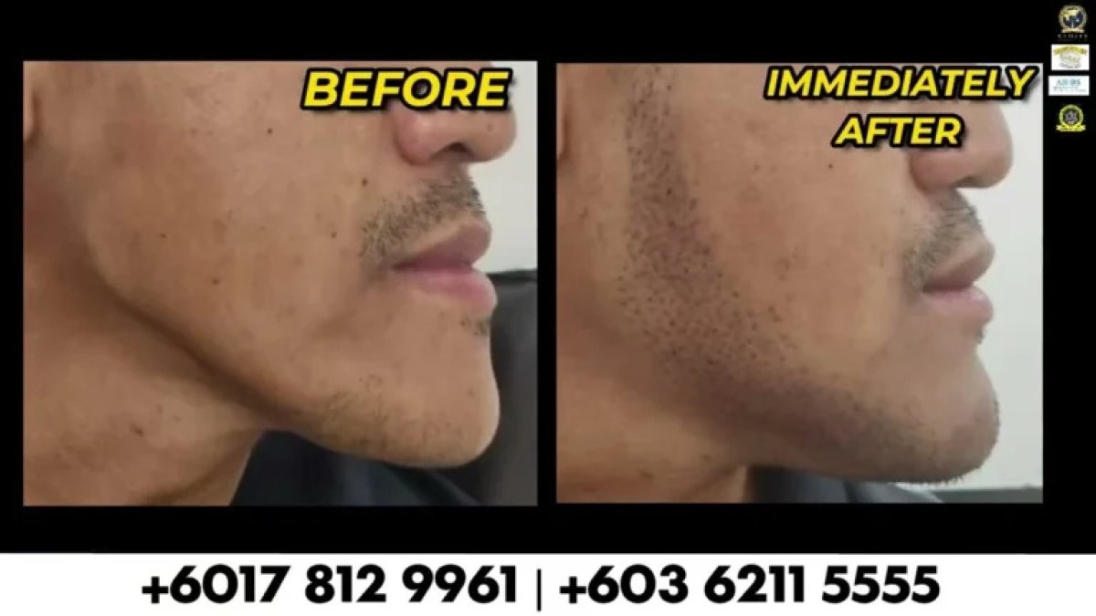 Before and after beard transplant results, improved facial hair density and contour