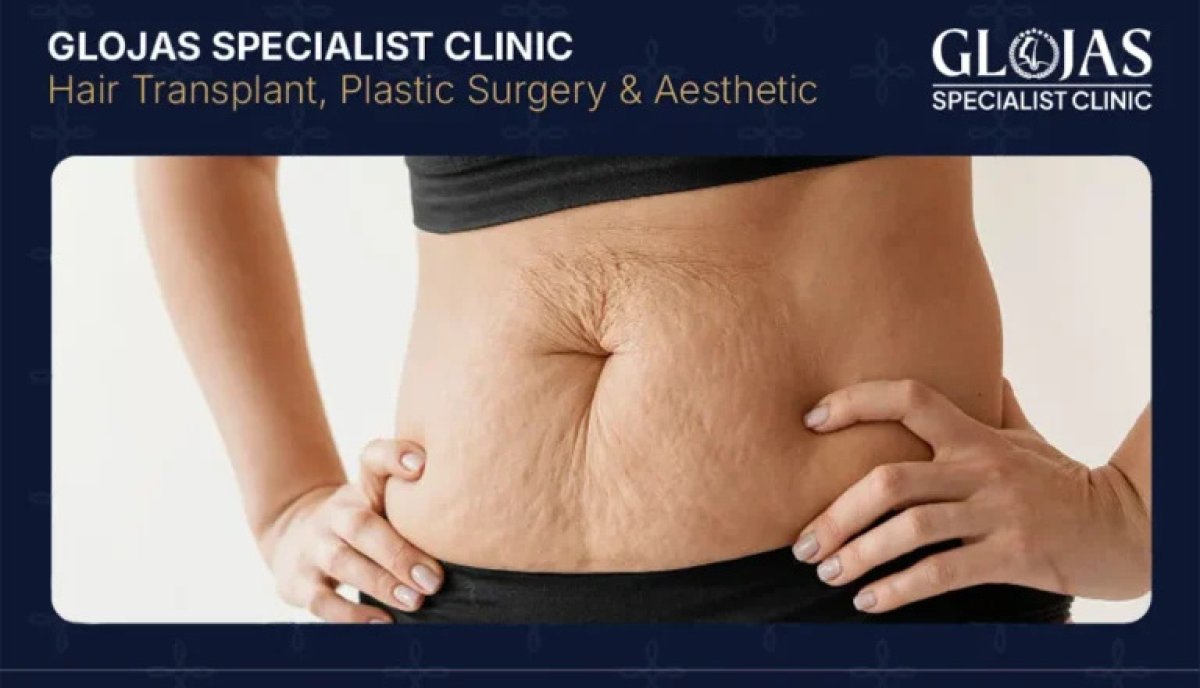 Tummy tuck candidate at Glojas Specialist Clinic, abdomen before abdominoplasty procedure