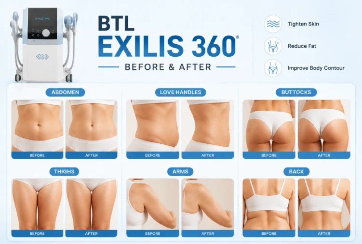 BTL Exilis 360 before and after results for abdomen, thighs, arms, back, buttocks, love handles