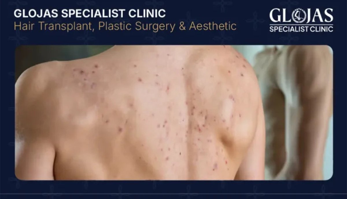 Medication therapy for acne result at Glojas Specialist Clinic – visible back skin improvement