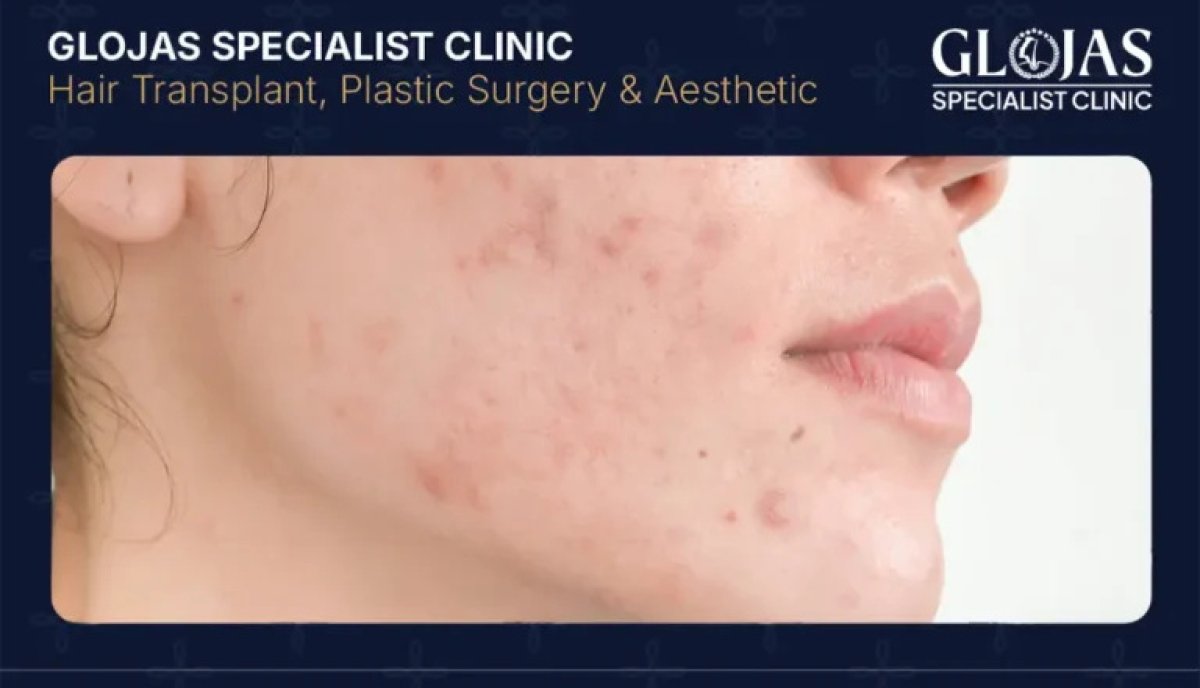 Acne medication therapy result at Glojas Specialist Clinic, visible facial skin improvement
