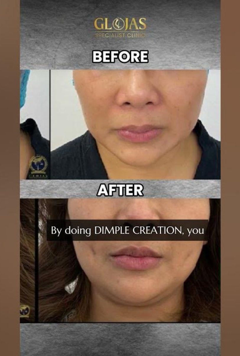 Before and after dimple creation surgery results at Glojas Specialist Clinic, enhanced cheeks