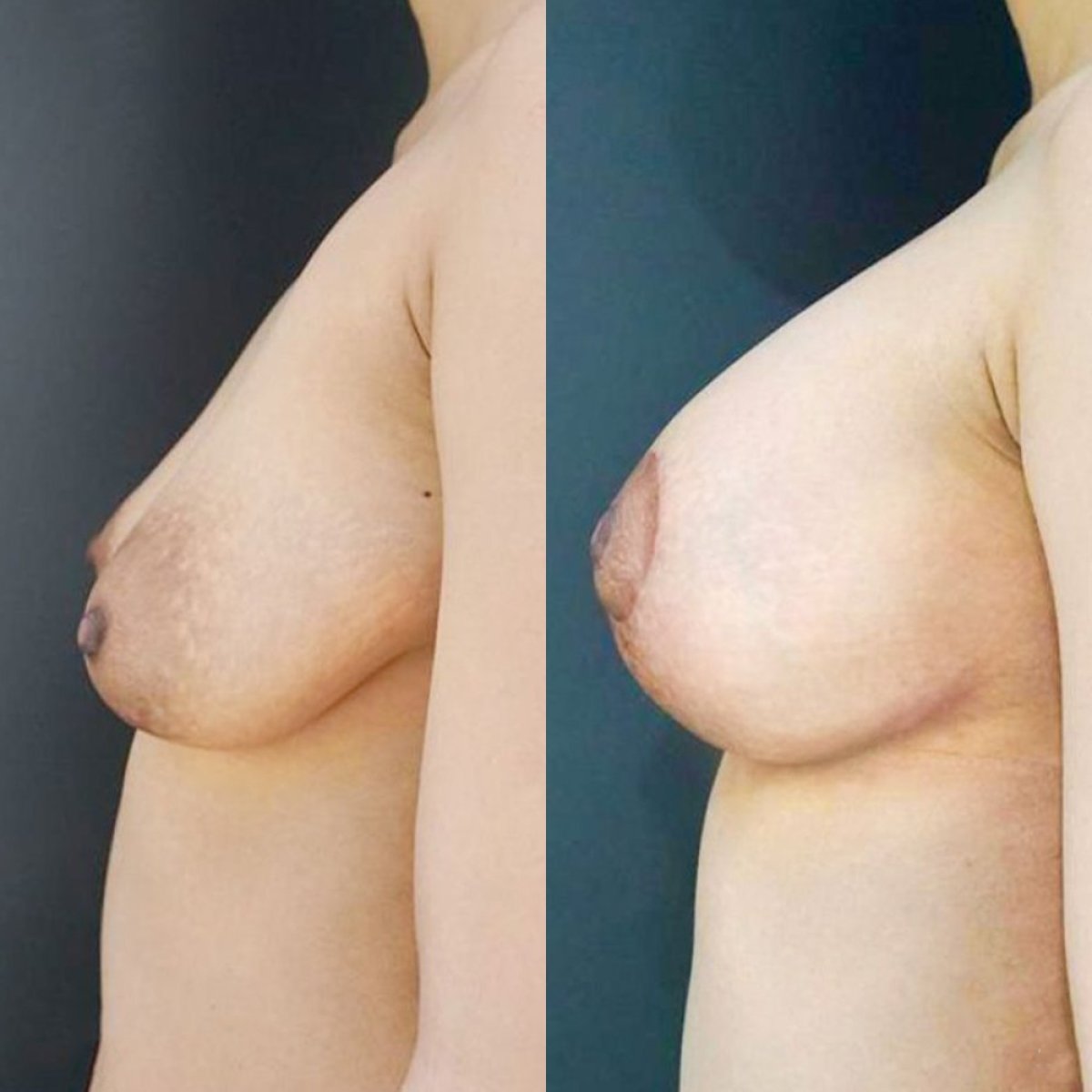 Before and after breast lift results at Cosmacare Clinic Center for Aesthetic Medicine and Plastic Surgery