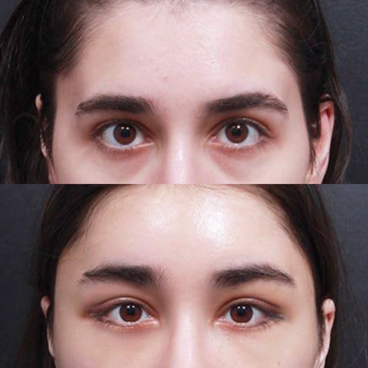 Vorher-nachher-Ergebnis Fox Eye Lift bei VG Plastic Surgery – angehobene äußere Augenwinkel