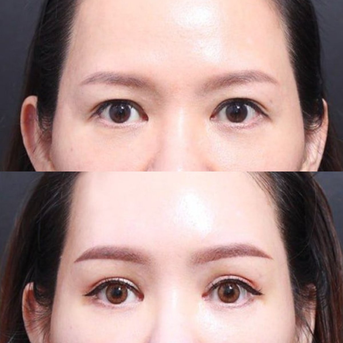 نتائج قبل وبعد Fox Eye Lift في VG Plastic Surgery، رفع وشد شكل العين