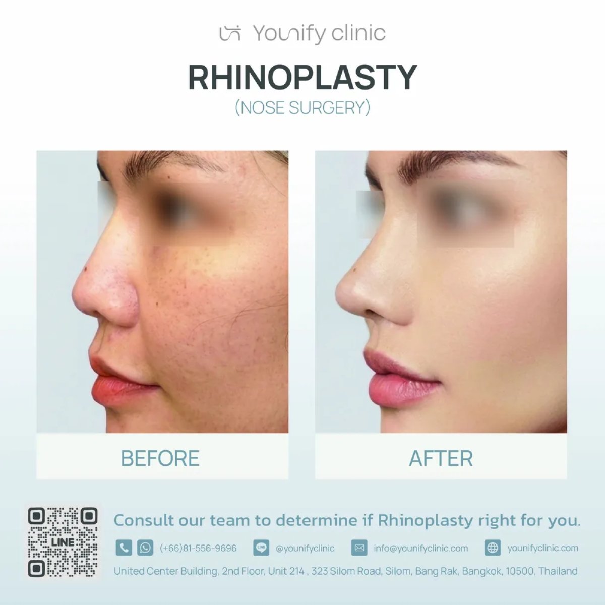 Before and after rhinoplasty results at Younify Clinic – nose reshaping with natural look