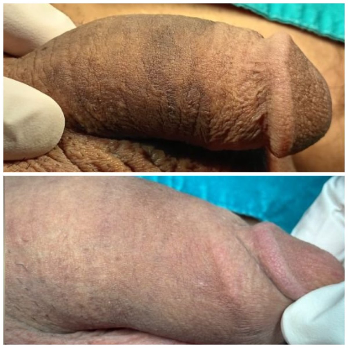نتائج قبل وبعد تكبير القضيب في عيادة Menness Wellness Clinic، تحسن ملحوظ بالحجم