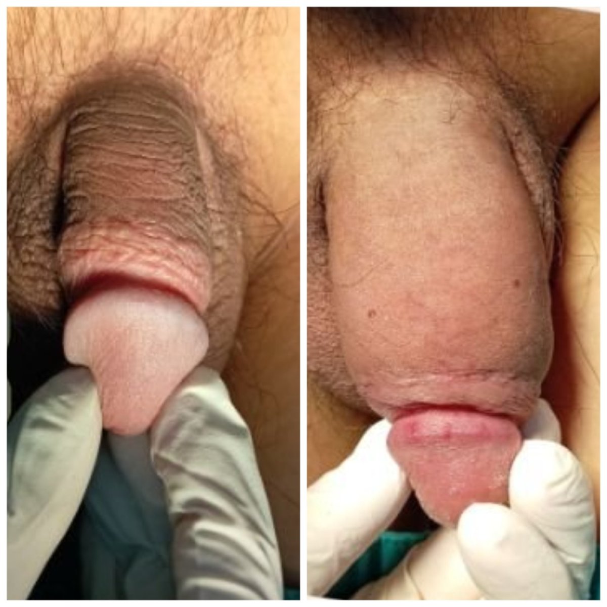 Before and after penis enlargement results at Menness Wellness Clinic, visible girth increase