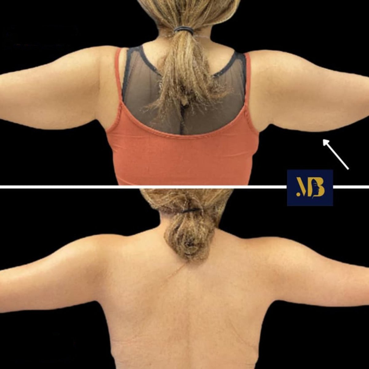 Before and after arm lift results at Michaël Benoilid Plastic and Cosmetic Surgeon Paris France