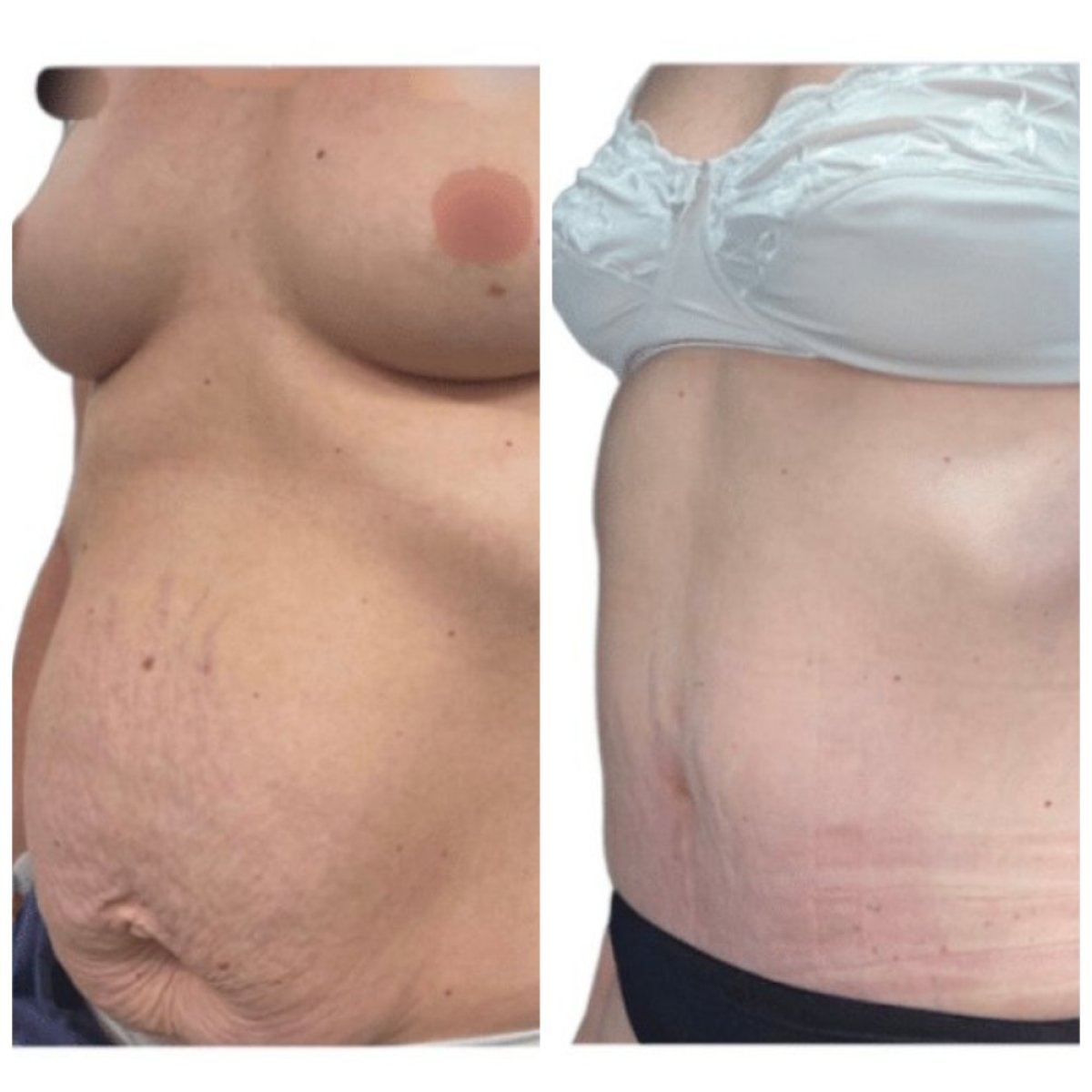 Resultados de abdominoplastia antes y después en Michaël Benoilid Plastic and Cosmetic Surgeon París