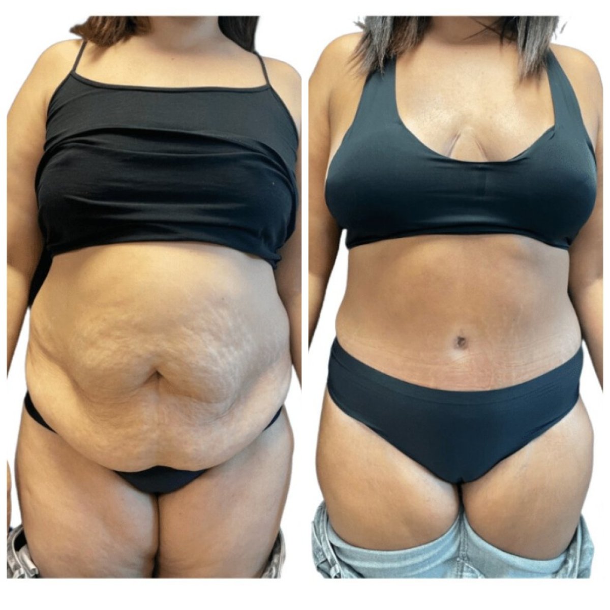 Before and after tummy tuck results at Michaël Benoilid Plastic and Cosmetic Surgeon Paris France