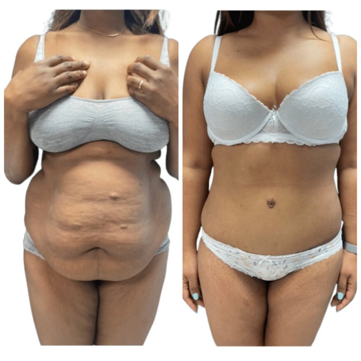 Resultados de abdominoplastia antes y después en Michaël Benoilid Plastic and Cosmetic Surgeon París