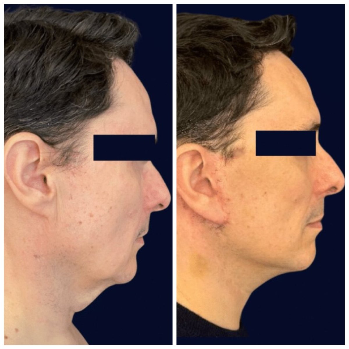 Facelift before and after results at Michaël Benoilid Plastic and Cosmetic Surgeon Paris France