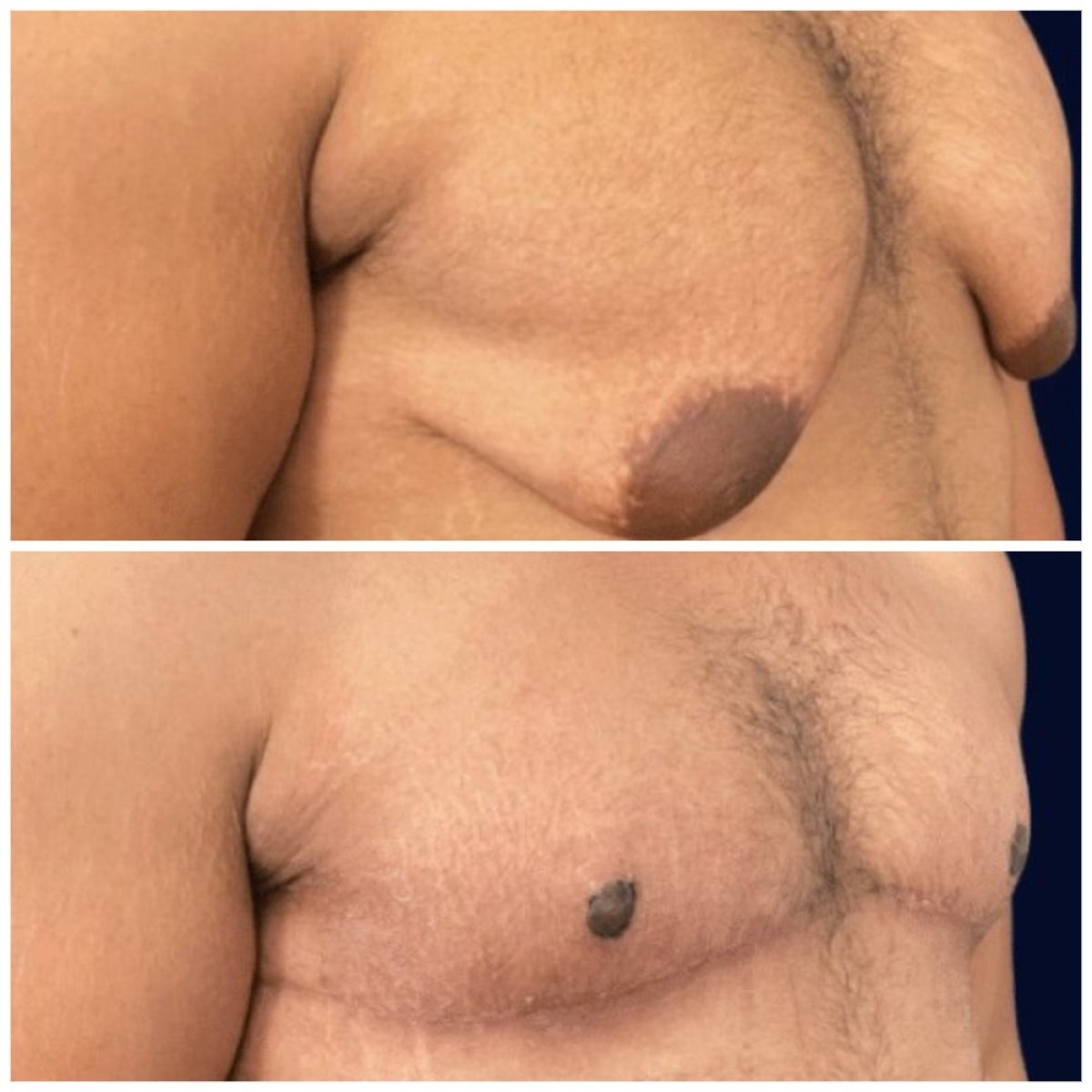 Before and after gynecomastia surgery results at Michaël Benoilid Plastic and Cosmetic Surgeon Paris